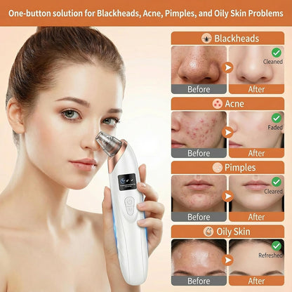 4‑in‑1 Blackhead Removal Suction Machine – Cell Operated
